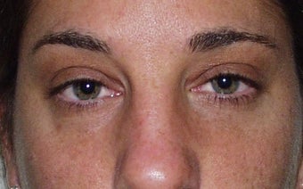 Blepharoplasty