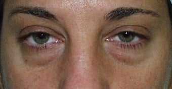 Blepharoplasty