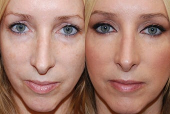 Lower eyelid rejuvenation with Silikon-1000