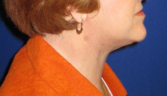 Neck lift