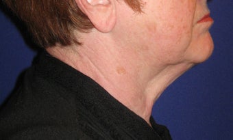 Neck lift