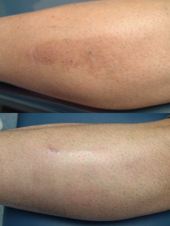 Intense Pulsed Light Laser