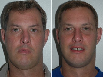 Revision Rhinoplasty