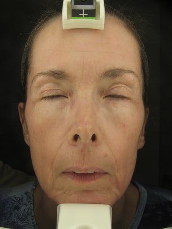 Fraxel Dual 1927 for Hyperpigmentation and wrinkles
