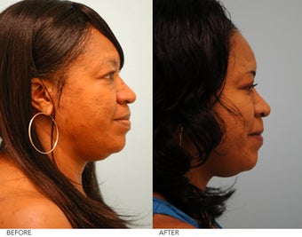 Lip Reduction