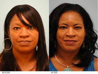 Lip Reduction