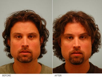 Botox Jaw Reduction