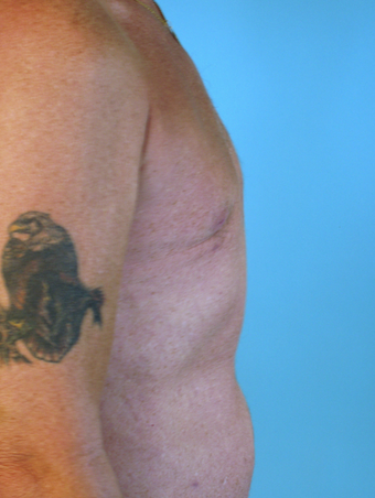 Male Breast Reduction