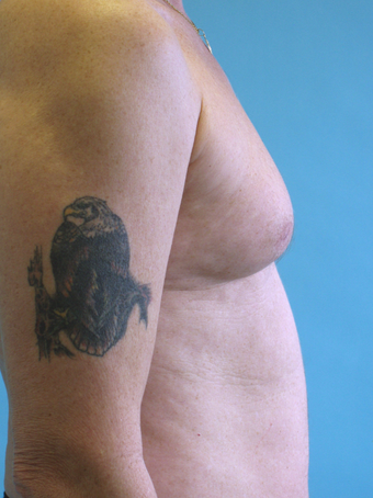 Male Breast Reduction
