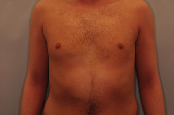 Vaser Liposuction