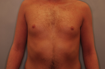 Vaser Liposuction