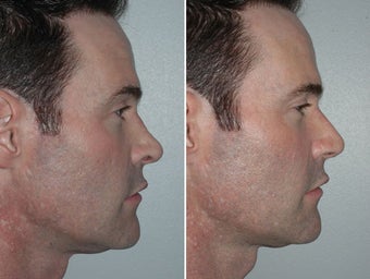 Revision Rhinoplasty