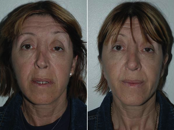 Revision Rhinoplasty