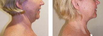 Neck Lift