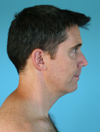 Neck Lift