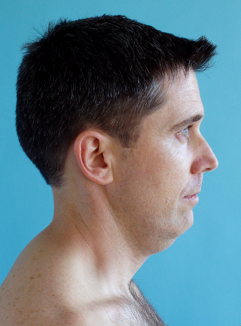 Neck Lift