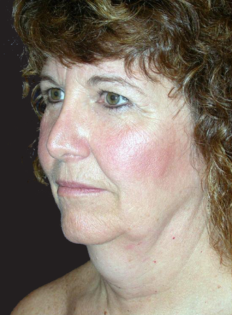 Neck Lift