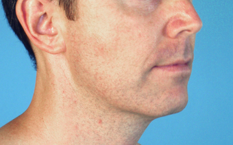Neck Lift