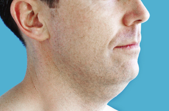 Neck Lift