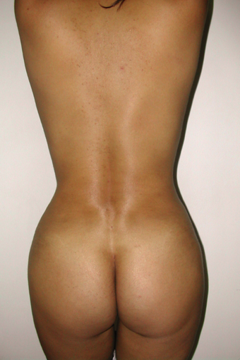 Back Lift
