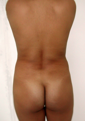Back Lift