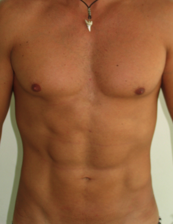 Tummy Liposuction