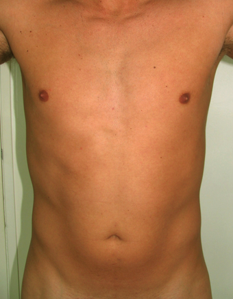 Tummy Liposuction