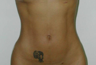 Vaser Liposuction