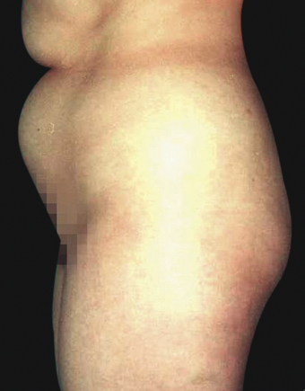 Tummy Liposuction