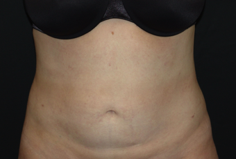 Tummy Liposuction