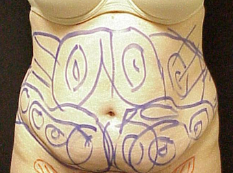 Tummy Liposuction