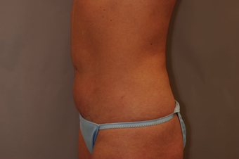 Tummy Liposuction