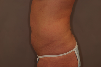 Tummy Liposuction