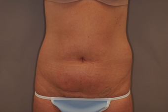Tummy Liposuction