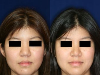 Rhinoplasty