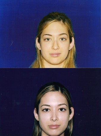 Rhinoplasty