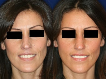 Non-Surgical Rhinoplasty
