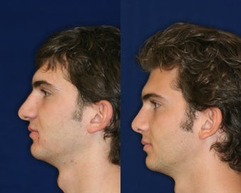 Rhinoplasty