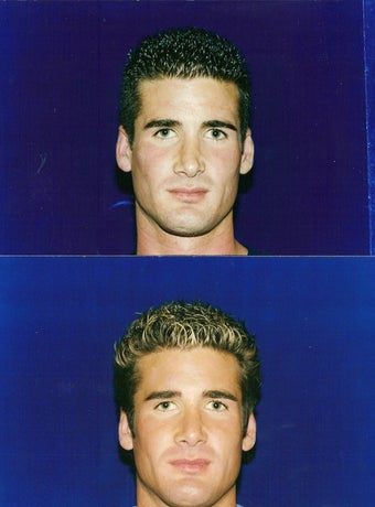 Revision Rhinoplasty