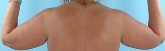 Arm Lift