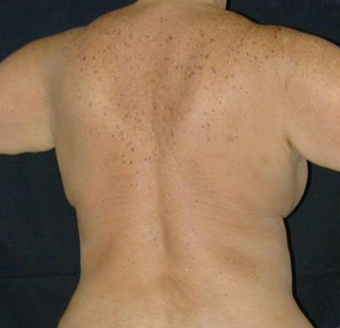 Back Lift