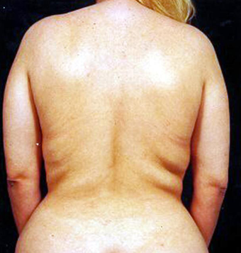 Back Lift