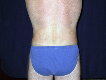 Back Lift