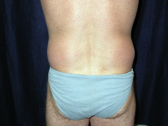 Back Lift