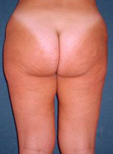 Butt Lift