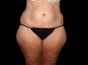 Lift of Thighs, Hips, and Butt