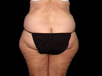 Lift of Thighs, Hips, and Butt
