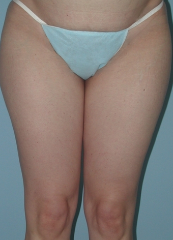 Thigh Lift