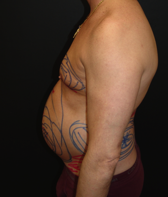 Tummy Liposuction