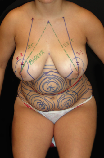 Breast Lift and Tummy Liposuction